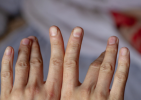 Hands with slightly bent fingers indicating trigger finger